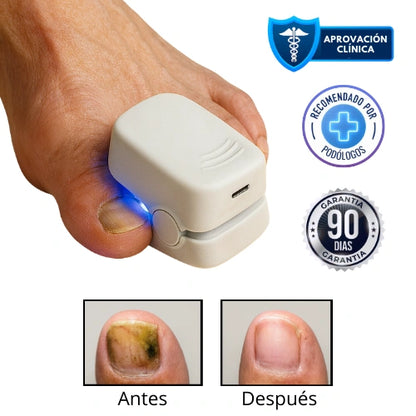 LumiNail Pro™ Elimina Hongos y Repara Uñas