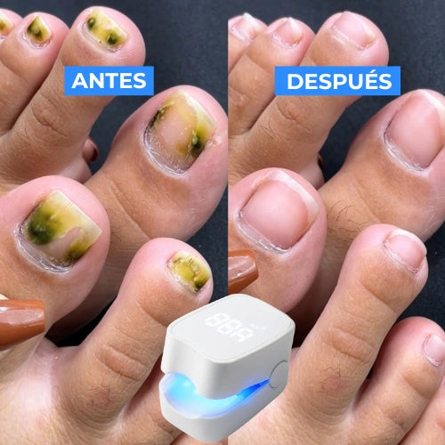 LumiNail Pro™ Elimina Hongos y Repara Uñas