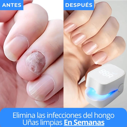 LumiNail Pro™ Elimina Hongos y Repara Uñas