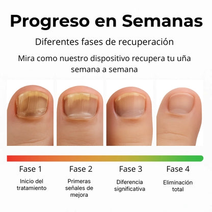 LumiNail Pro™ Elimina Hongos y Repara Uñas