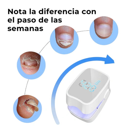 LumiNail Pro™ Elimina Hongos y Repara Uñas